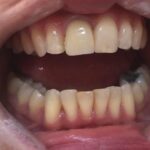 higienistka-stomatologiczna-szkolenie-praktyczne-wybielania-zebow-6